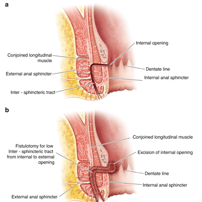 Fistula