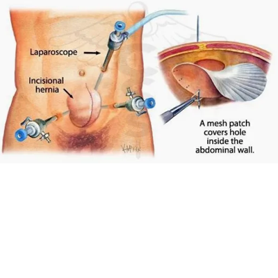 Hernia