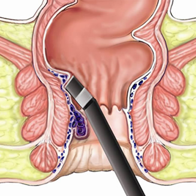 Piles / Hemorrhoids